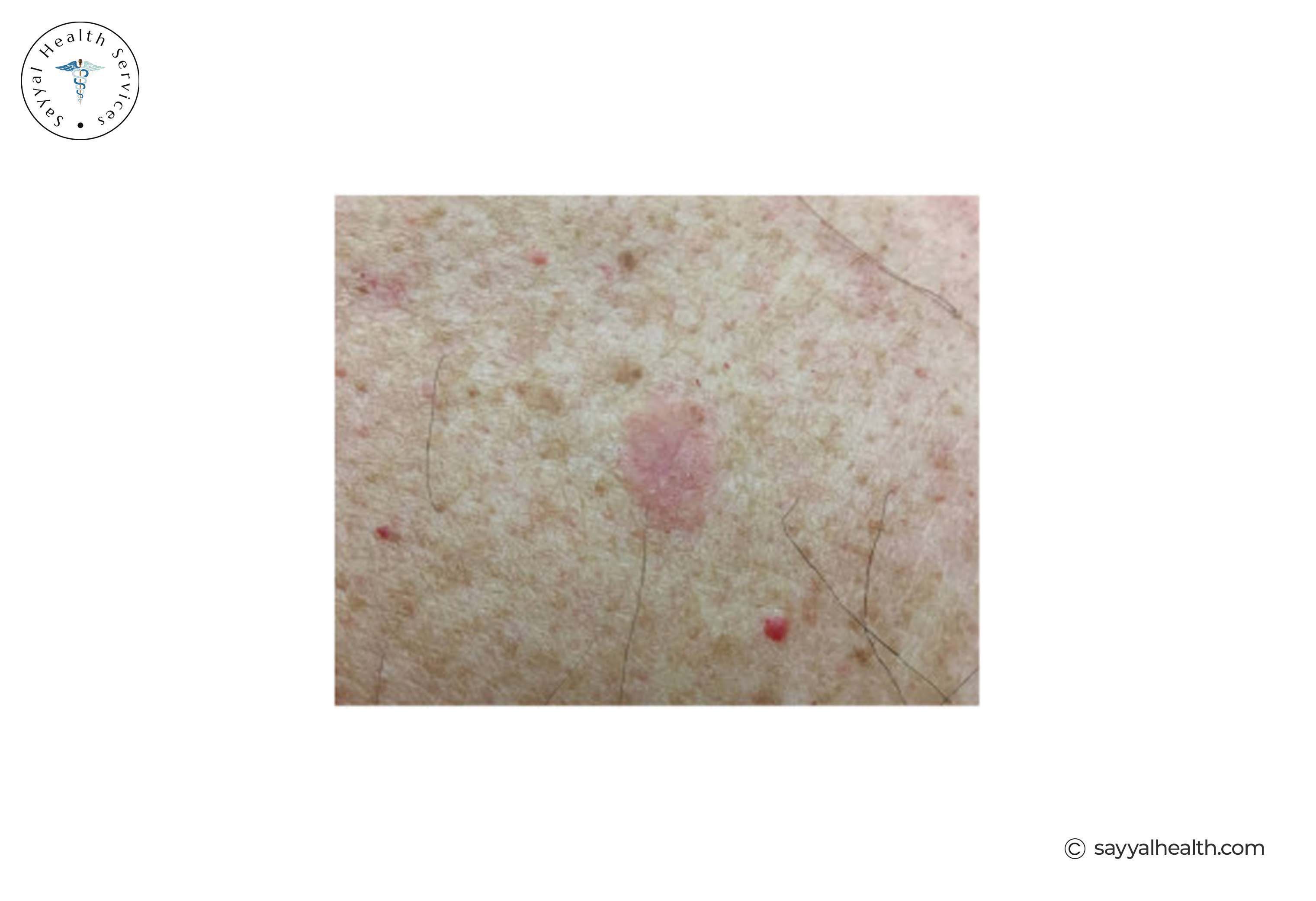 picture of Amelanotic Melanoma